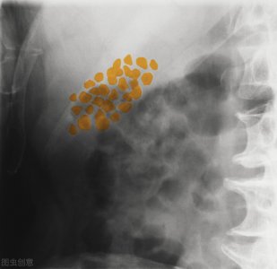 ​肾结石有哪些症状呢（肾结石有什么症状？5个信号提示你肾结石可能来临）