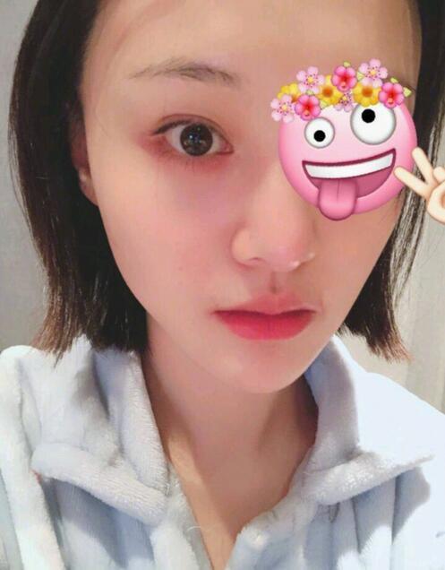 郑爽晒受伤素颜照,网友心疼:她怎么总是受伤啊!