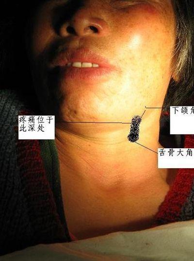 上口下巴(下巴与上颚衔接处疼)