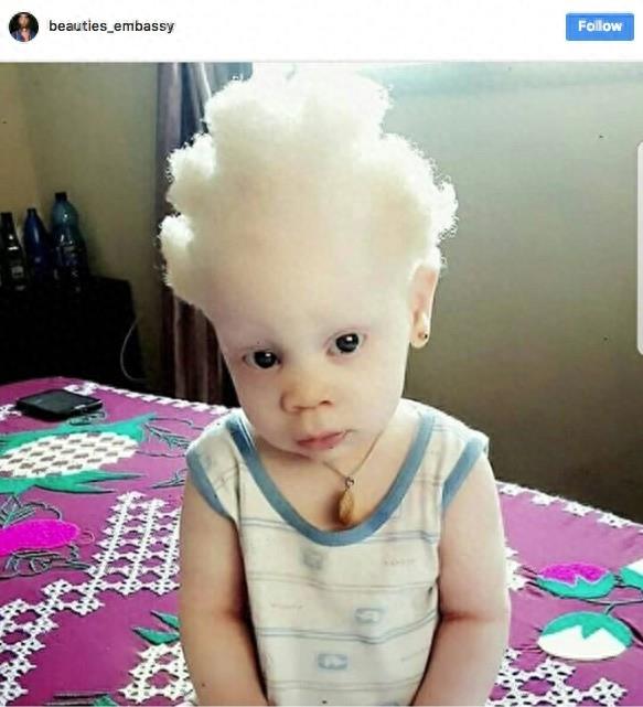 22张不同种族白化症之美的照片!