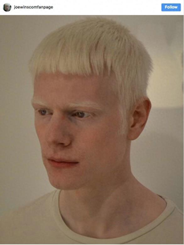 22张不同种族白化症之美的照片!