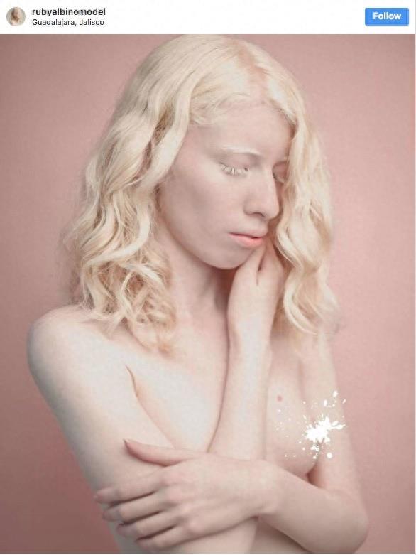 22张不同种族白化症之美的照片!