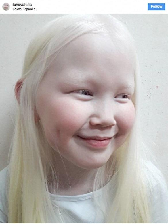 22张不同种族白化症之美的照片!