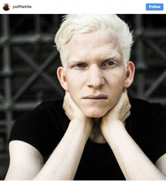 22张不同种族白化症之美的照片!