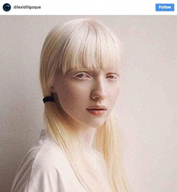 22张不同种族白化症之美的照片!