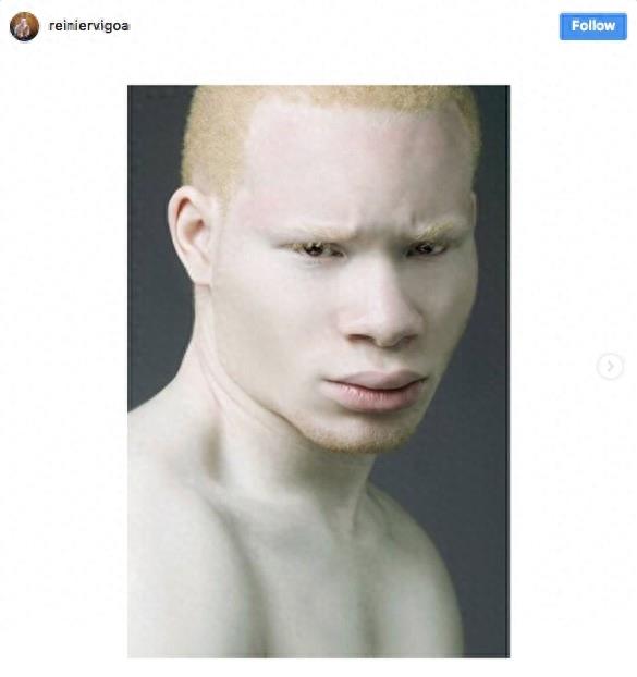 22张不同种族白化症之美的照片!