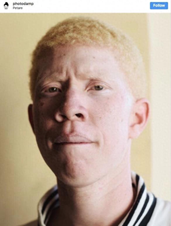 22张不同种族白化症之美的照片!