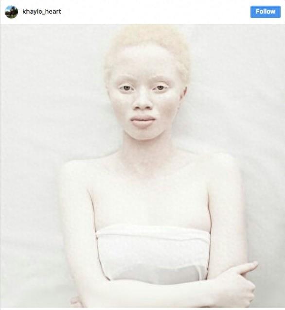 22张不同种族白化症之美的照片!