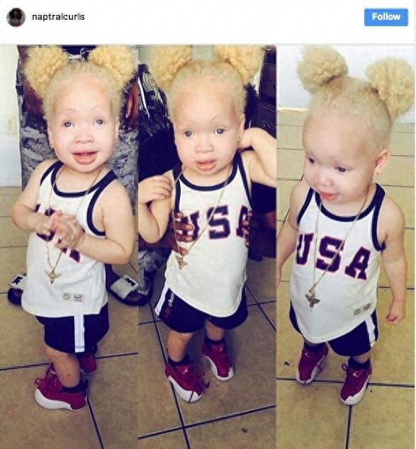 22张不同种族白化症之美的照片!