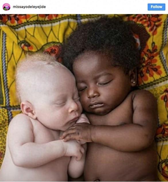 22张不同种族白化症之美的照片!