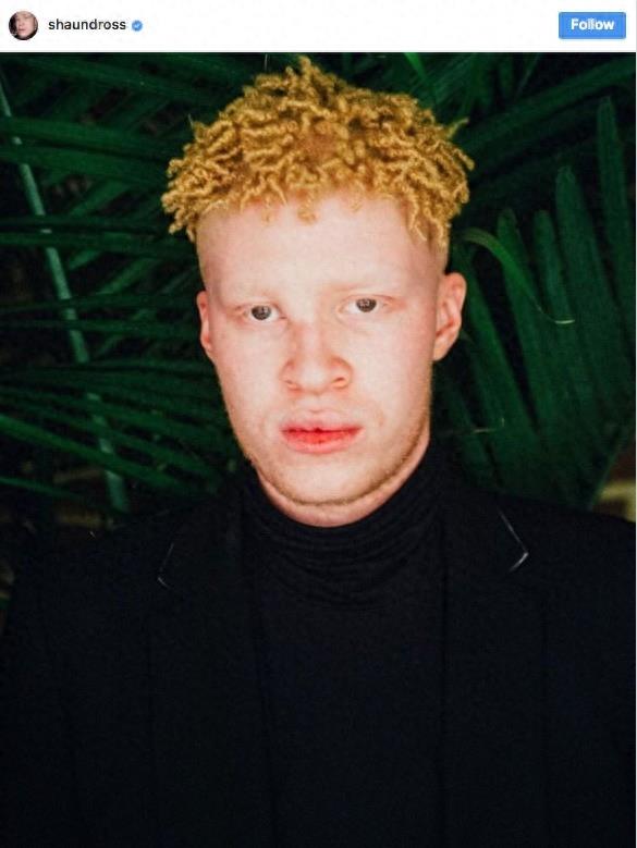 22张不同种族白化症之美的照片!