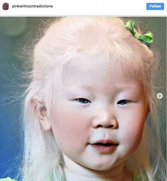 22张不同种族白化症之美的照片!