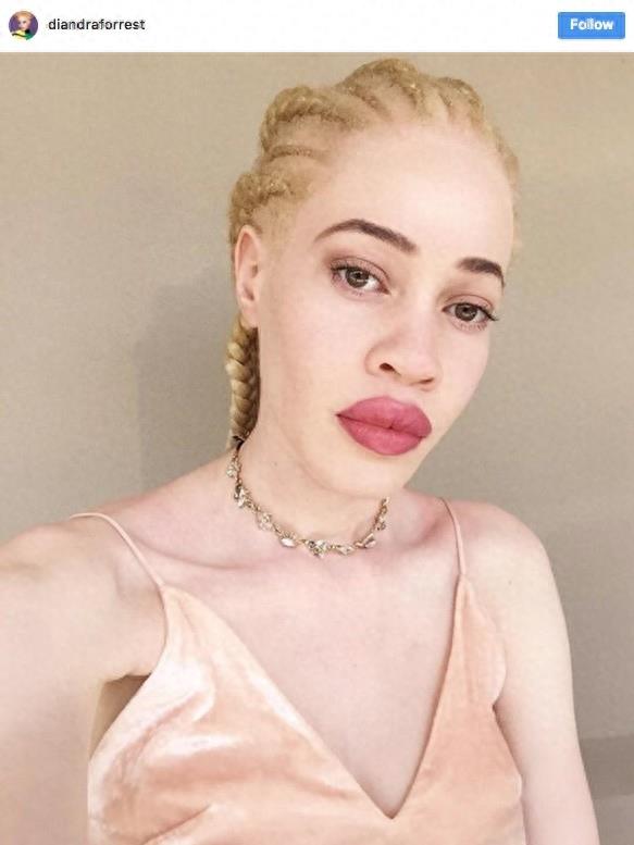 22张不同种族白化症之美的照片!