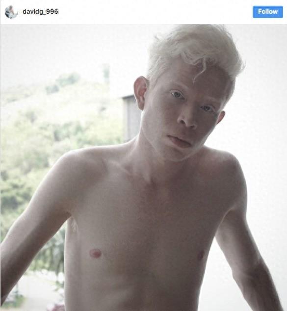 22张不同种族白化症之美的照片!