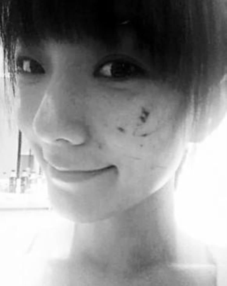 周冬雨下巴的疤痕怎么弄得「素颜的周冬雨下巴现3厘米疤痕而今才知道杨幂爱照半边脸的原因」