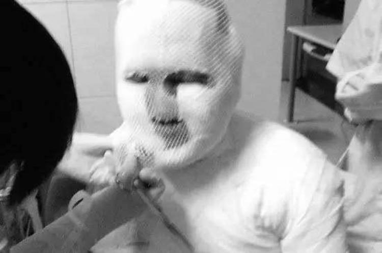 周冬雨下巴的疤痕怎么弄得「素颜的周冬雨下巴现3厘米疤痕而今才知道杨幂爱照半边脸的原因」