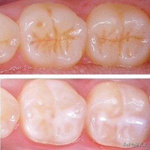 ​窝沟封闭是智商税吗？口腔医生揭秘：真相与误解全解析