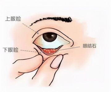 ​眼睛里长“石头”？